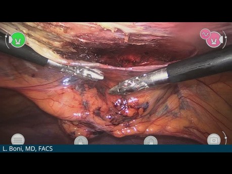 Reparación de hernia umbilical con Versius - Luigi Boni