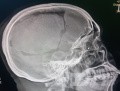 Craniectomía descompresiva en infarto maligno de la arteria cerebral media