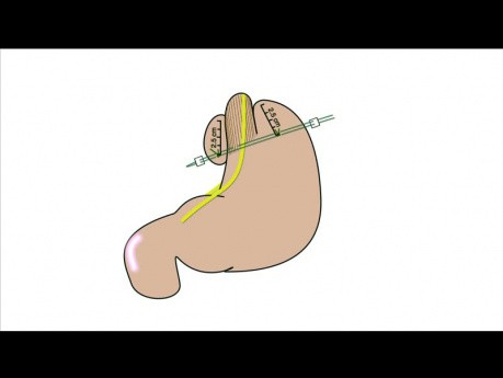 Tutorial de la aplicación de fundoplicatura de geometría; Capítulo 08 - Animación de fundoplicatura
