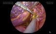 Conducto hepático derecho aberrante que entra a un conducto cístico corto diagnosticado mediante colecistectomía laparoscópica