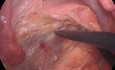 Escisión mesorrectal total laparoscópica (EMT) para cáncer rectal bajo con ICG