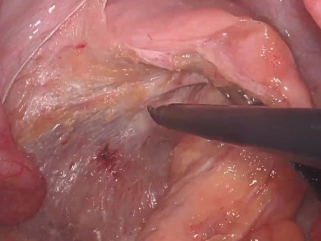 Escisión mesorrectal total laparoscópica (EMT) para cáncer rectal bajo con ICG