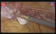 3D en vivo - histerectomía total laparoscópica, tratamiento de miomas uterinos