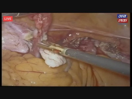 3D en vivo - histerectomía total laparoscópica, tratamiento de miomas uterinos
