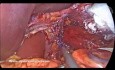 Directrices para la evaluación intraoperatoria de hernias de hiato deslizantes tipo I