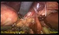Escisión laparoscópica de quistes coledocianos
