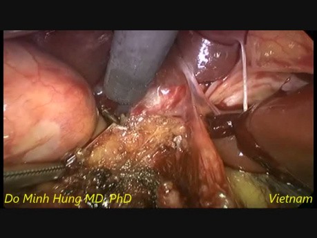 Escisión laparoscópica de quistes coledocianos