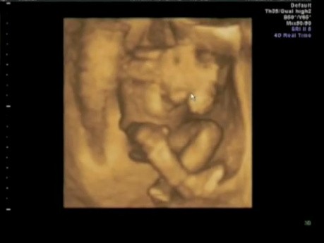 Imagen de ultrasonido del embarazo