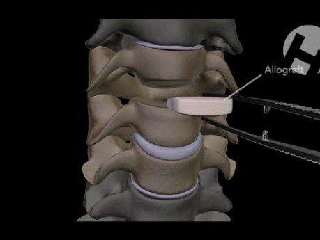 Discectomía cervical C3-C5, implantación