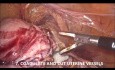 Técnica de histerectomía laparoscópica