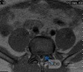 Microdiscectomía Lumbar