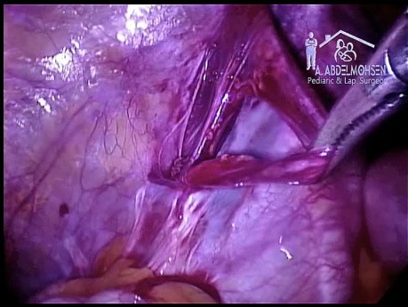 Varicocelectomía laparoscópica