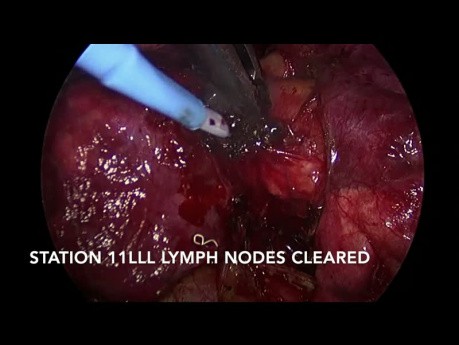 Lobectomía inferior izquierda toracoscópica asistida por video del pulmón para el cáncer de células no pequeñas