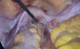 Reseccion anterior baja laparoscopica por nm de recto medio