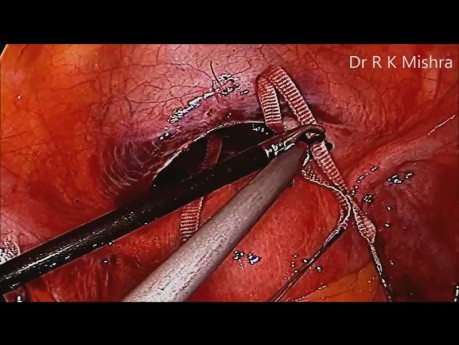 Cerclaje Cervical Laparoscópico por Incompetencia o Insuficiencia Cervical