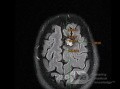 Estirpación de cavernoma subcortical 