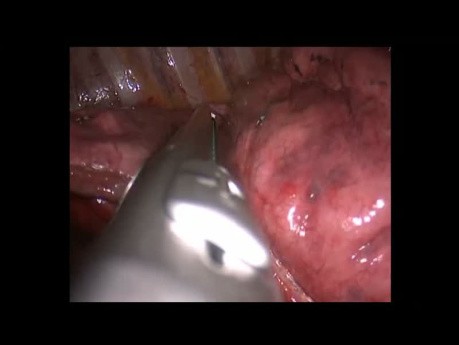 Única etapa VATS Bilateral Uniportal Anatomic S3 