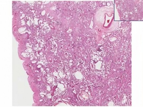 Fibrosis intersticial difusa - histopatología - pulmón