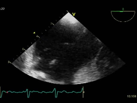 Los cables del marcapasos causaron una endocarditis infecciosa