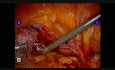 Sacrocolpopexia de la cúpula vaginal - paciente poshisterectomía