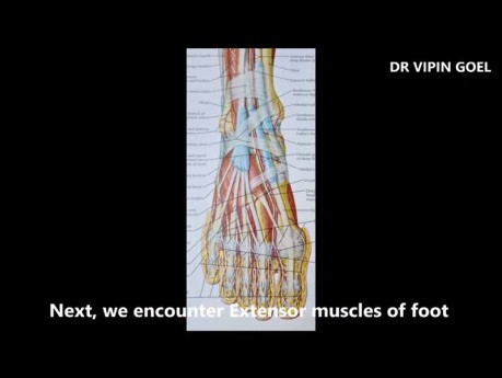 Amputación de pie por melanoma plantar maligno (amputación de Lisfranc)