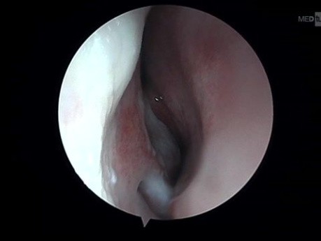 Luxación de cuadrangular con choque turbinoseptal