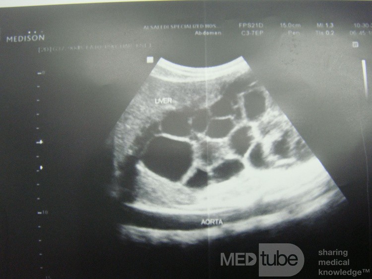 Quiste hidatídico hepático - ecografía abdominal