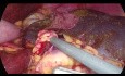 Esplenectomía laparoscópica en paciente con agenesia del páncreas dorsal - técnica de primeros vasos 