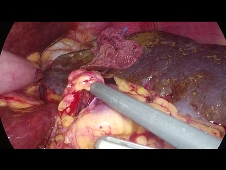 Esplenectomía laparoscópica en paciente con agenesia del páncreas dorsal - técnica de primeros vasos 