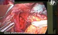Funduplicatura laparoscópica de Nissen y herniorrafia de hiato después de una ablación de la mucosa antirreflujo fallida