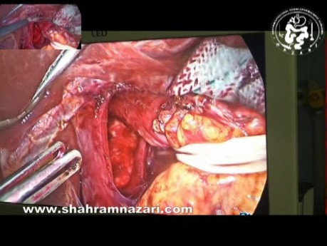 Funduplicatura laparoscópica de Nissen y herniorrafia de hiato después de una ablación de la mucosa antirreflujo fallida