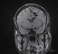 Estirpación de cavernoma subcortical 