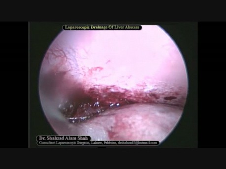 Drenaje laparoscópico de absceso hepático