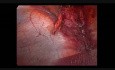 Hernia umbilical y diástasis de los rectos