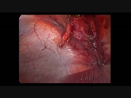 Hernia umbilical y diástasis de los rectos