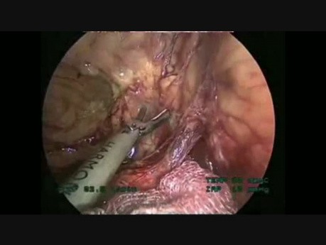Colectomía izquierda laparoscópica - paso a paso