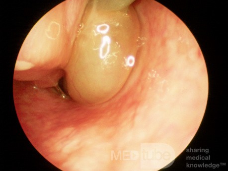 Pólipo antrocoanal izquierdo 2