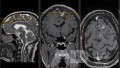 Estirpación de cavernoma subcortical 
