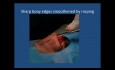 Clases de rinoplastia - Sesión 14, Colgajos esparcidores en reducción