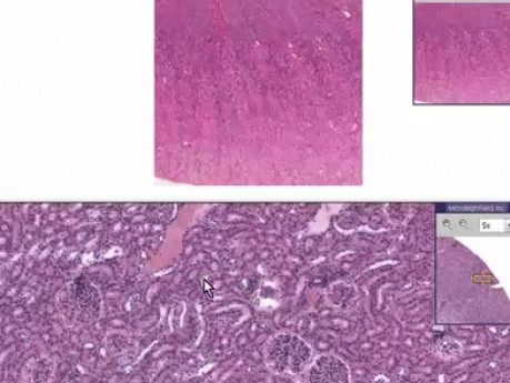 Nefrocalcinosis - histopatología - riñón