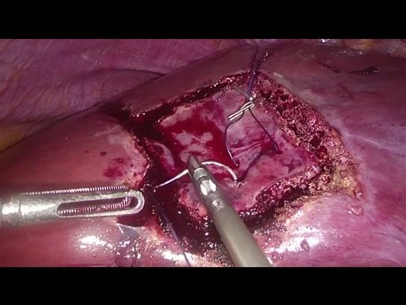 Técnica de dimano de resección hepática laparoscópica no anatómica 