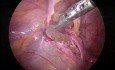 Cirugía de hernia en un niño