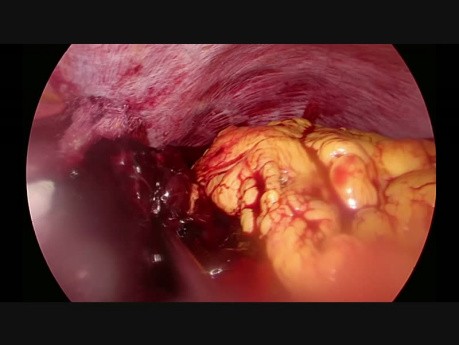 Hemorragia después de la resección laparpscópica del estómago  