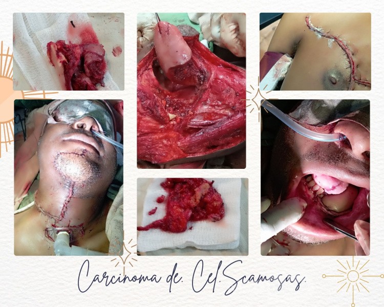 Carcinoma epidermoide de lengua