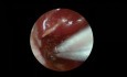 Timpanoplastia endoscópica transcanal para otitis media supurativa crónica activa