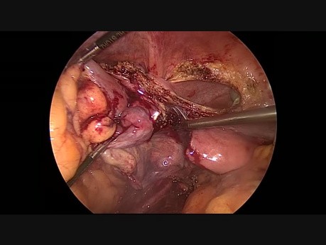 Sigmoidectomía laparoscópica en bloque, anexectomía izquierda, intestino delgado parcial más resección parcial de vejiga urinaria para tumor sigmoideo avanzado