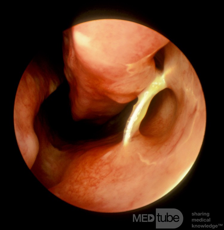Cuerpo extraño nasal