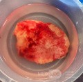 Craniectomía descompresiva en infarto maligno de la arteria cerebral media
