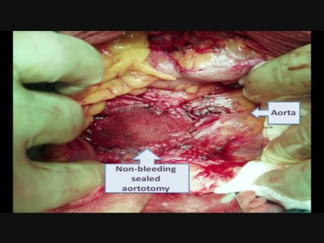 Perforación de aorta durante la laparoscopia