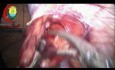 Varicocelectomía laparoscópica con preservación de la arteria